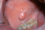 Escissione fibroma