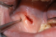 Escissione fibroma