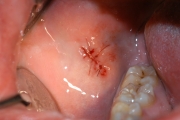 Escissione fibroma